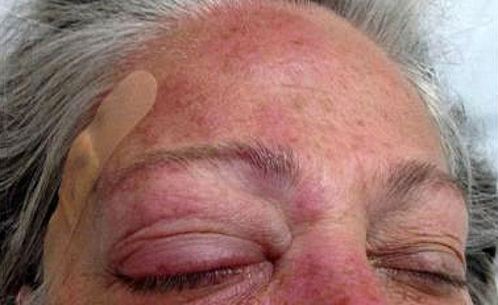 El jueves, jornada sobre el Herpes Zóster en el Instituto de Estudios de Ciencias de la Salud