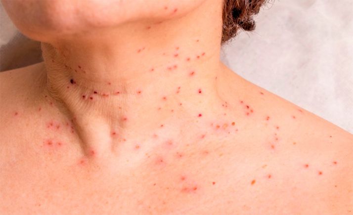 La Junta invertirá 1,2 M&euro; para adquirir vacunas contra el papiloma humano 