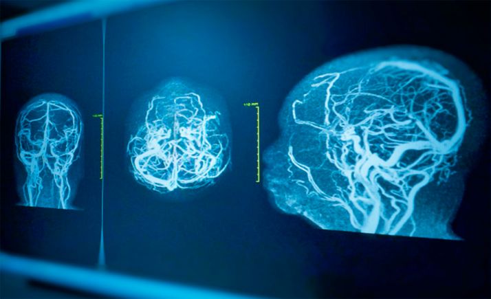 El aumento de casos de ictus el año pasado no se corresponde con el Covid 