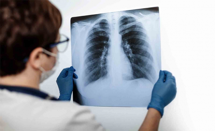 Un estudio apunta los distintos patrones de daño pulmonar en las víctimas del coronavirus