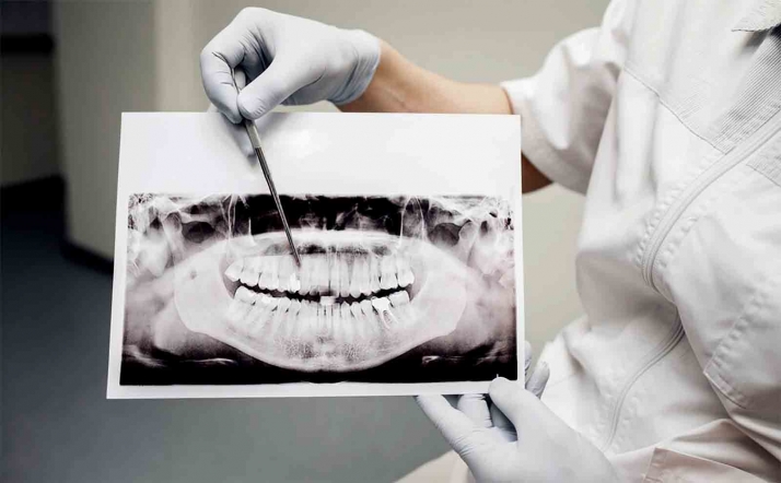 34 millones de personas en España tienen caries