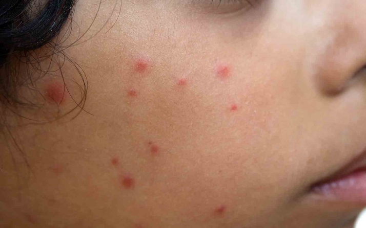 Castilla y León destina más de 5 M&euro; para vacunas frente al herpes zóster