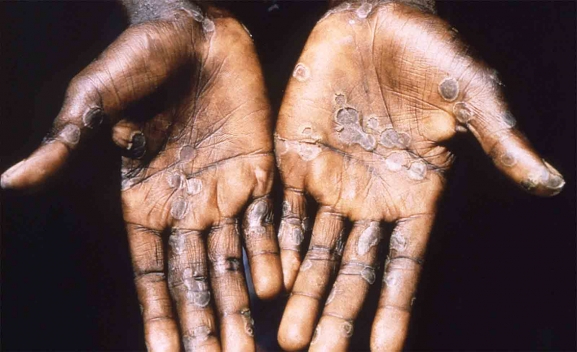 Detectados tres nuevos casos de Viruela del Mono en Castilla y León