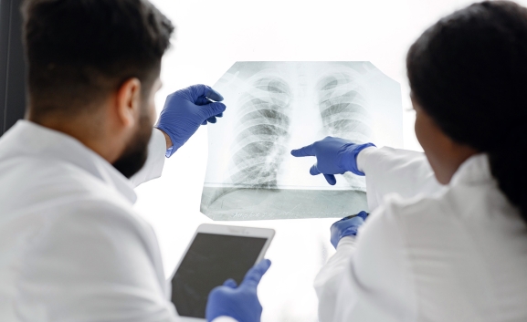 Científicos descubren clave del cáncer de pulmón en proteína